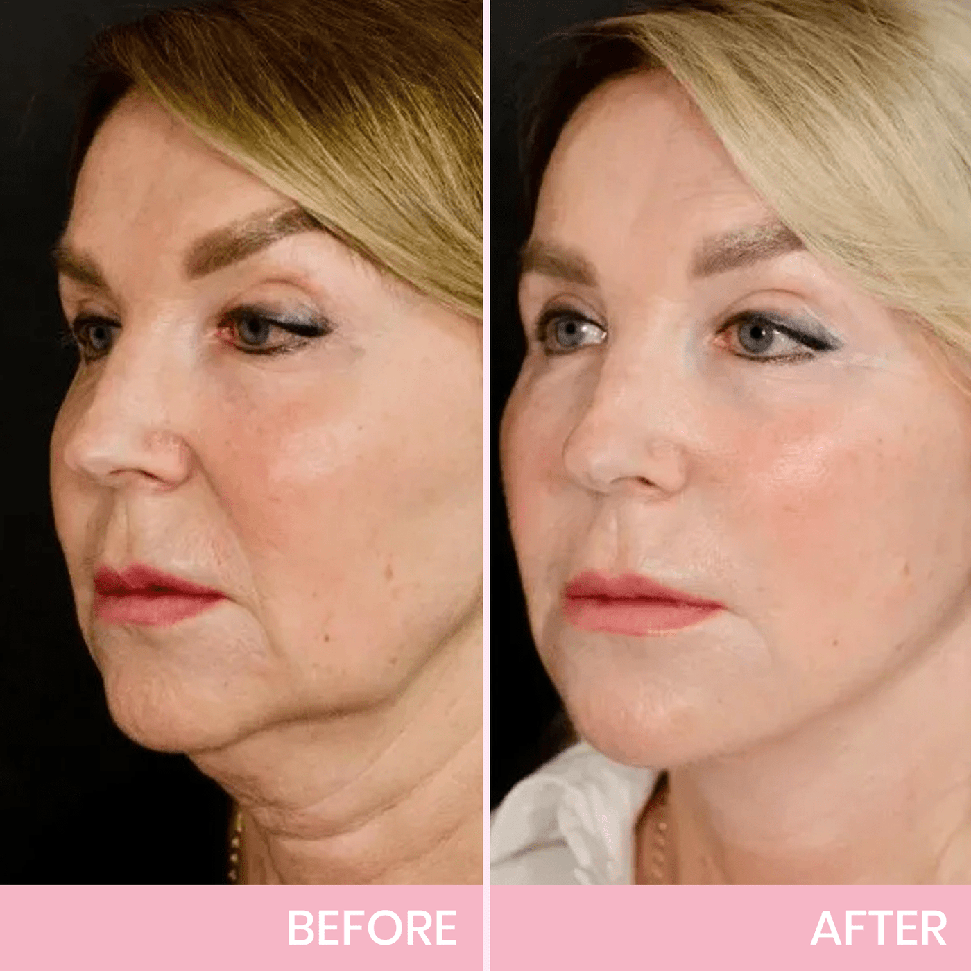 Instant V-Lift Tape – Lift Years Off Instantly! - 60% OFF